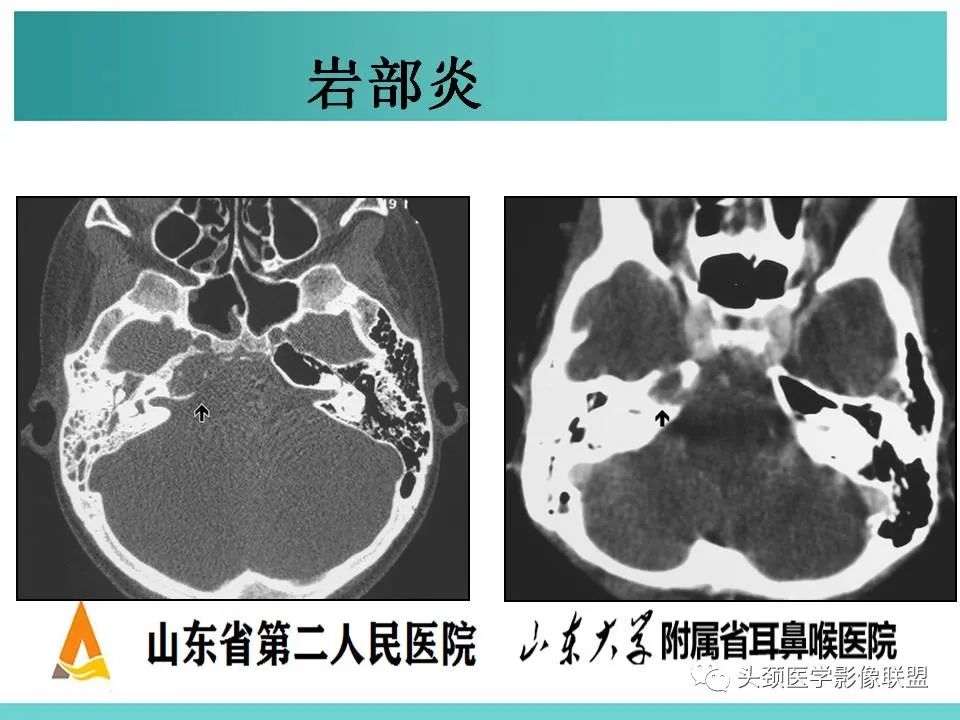 影像PPT - 【PPT】慢性中耳乳突炎-115