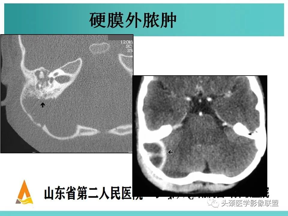 影像PPT - 【PPT】慢性中耳乳突炎-116