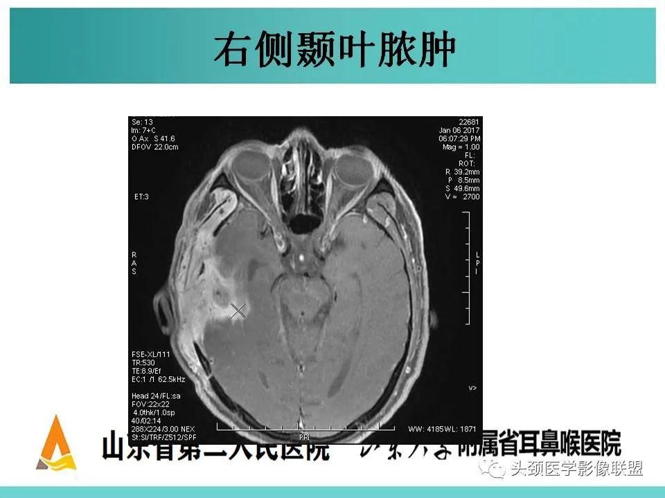 影像PPT - 【PPT】慢性中耳乳突炎-118