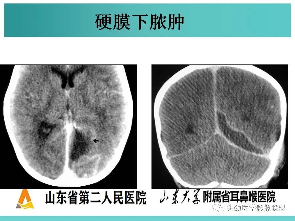 影像PPT - 【PPT】慢性中耳乳突炎-117