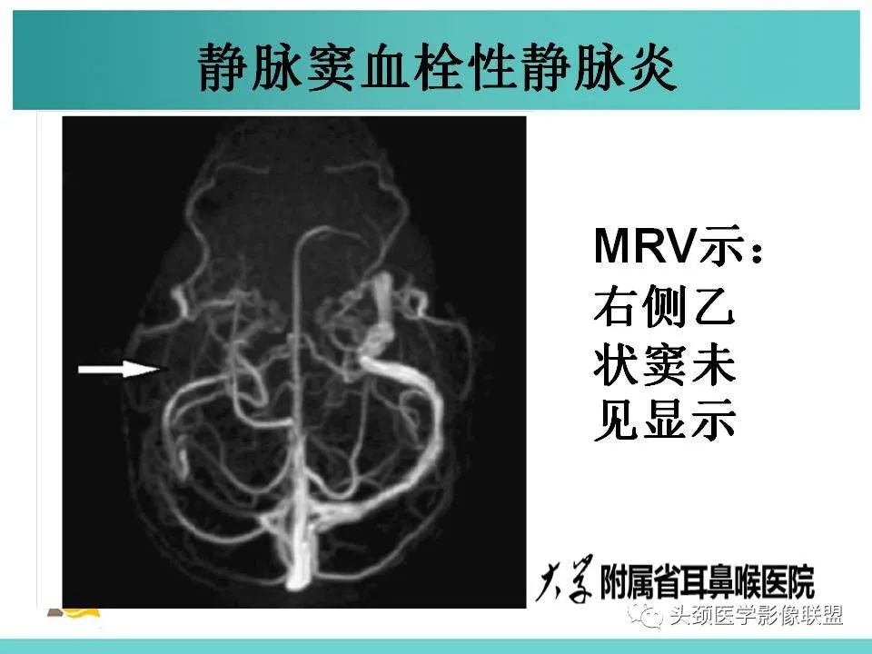 影像PPT - 【PPT】慢性中耳乳突炎-120