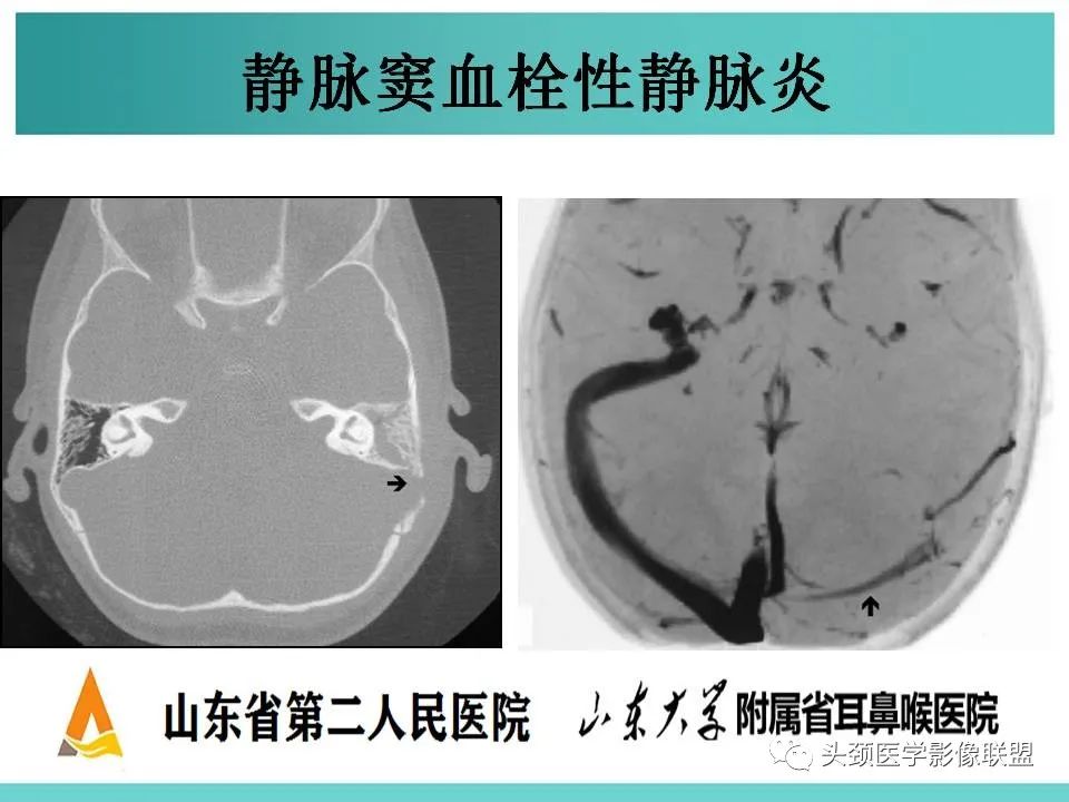 影像PPT - 【PPT】慢性中耳乳突炎-119