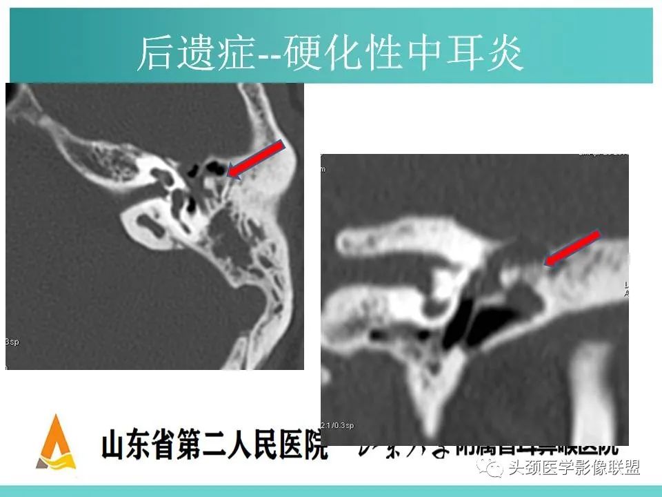 影像PPT - 【PPT】慢性中耳乳突炎-128