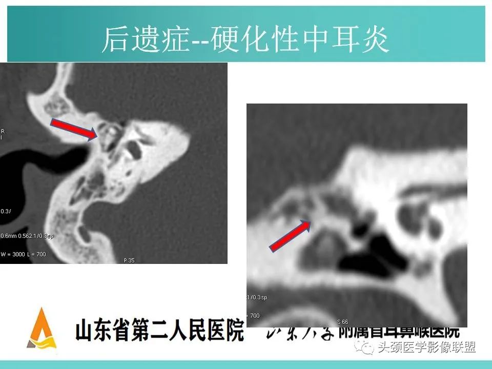 影像PPT - 【PPT】慢性中耳乳突炎-129