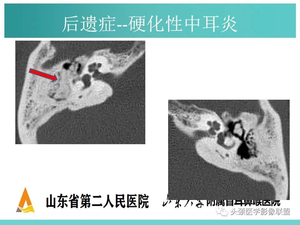 影像PPT - 【PPT】慢性中耳乳突炎-130