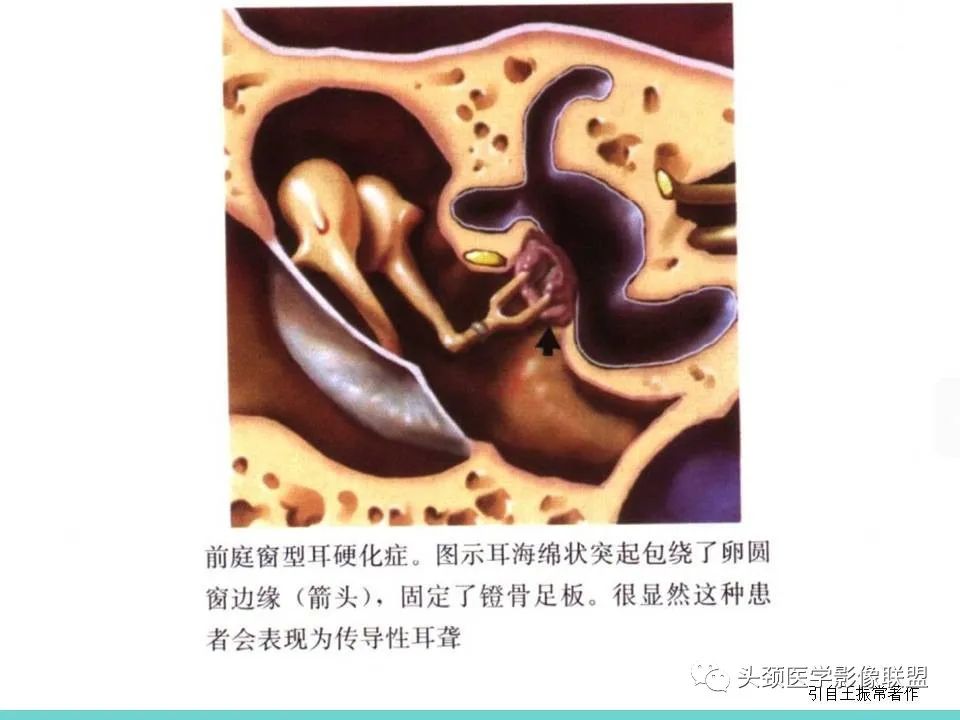影像PPT - 【PPT】慢性中耳乳突炎-133