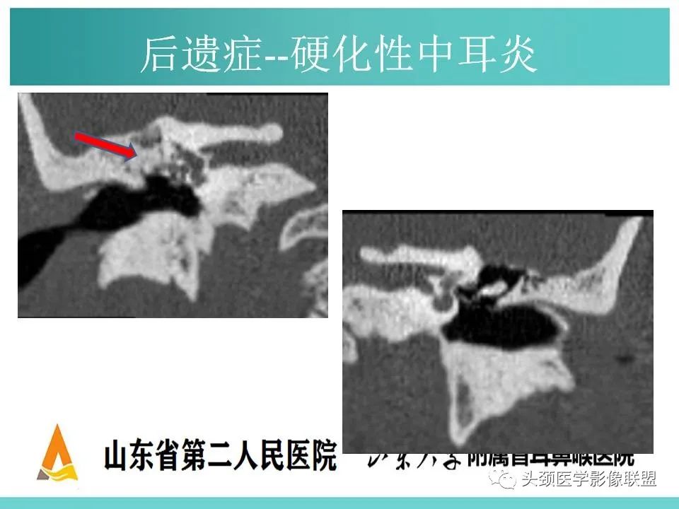 影像PPT - 【PPT】慢性中耳乳突炎-131