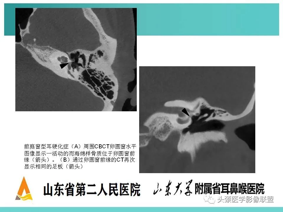 影像PPT - 【PPT】慢性中耳乳突炎-134