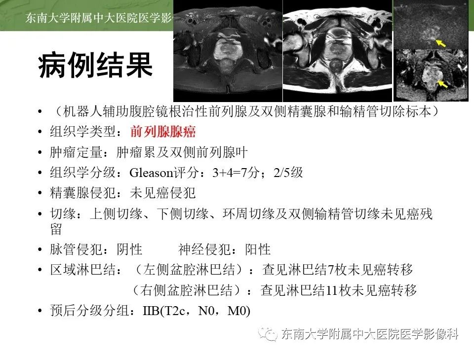 影像PPT - 【PPT】前列腺癌TNM分期-2