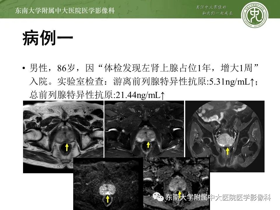 影像PPT - 【PPT】前列腺癌TNM分期-14