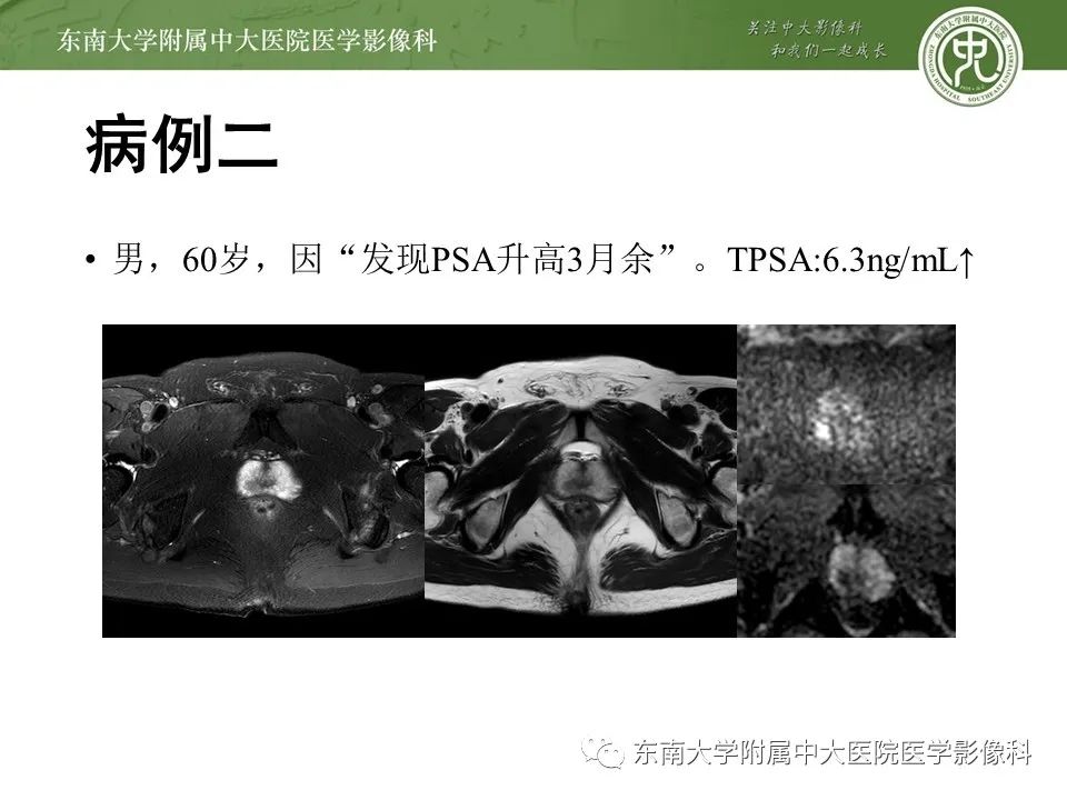 影像PPT - 【PPT】前列腺癌TNM分期-16