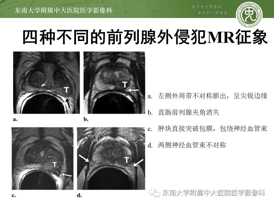 影像PPT - 【PPT】前列腺癌TNM分期-19