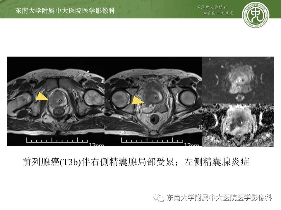 影像PPT - 【PPT】前列腺癌TNM分期-24