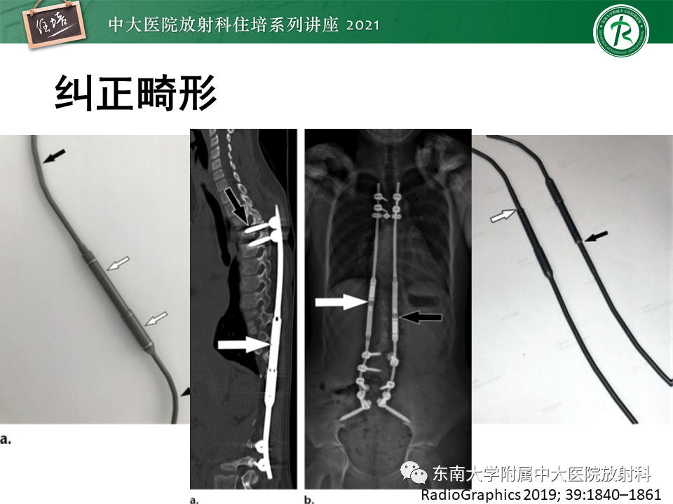 影像PPT - 【PPT】脊柱术后影像学评估-6