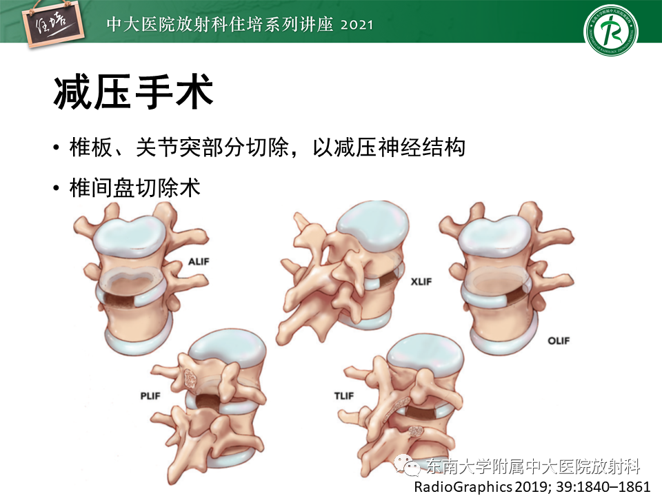 影像PPT - 【PPT】脊柱术后影像学评估-3