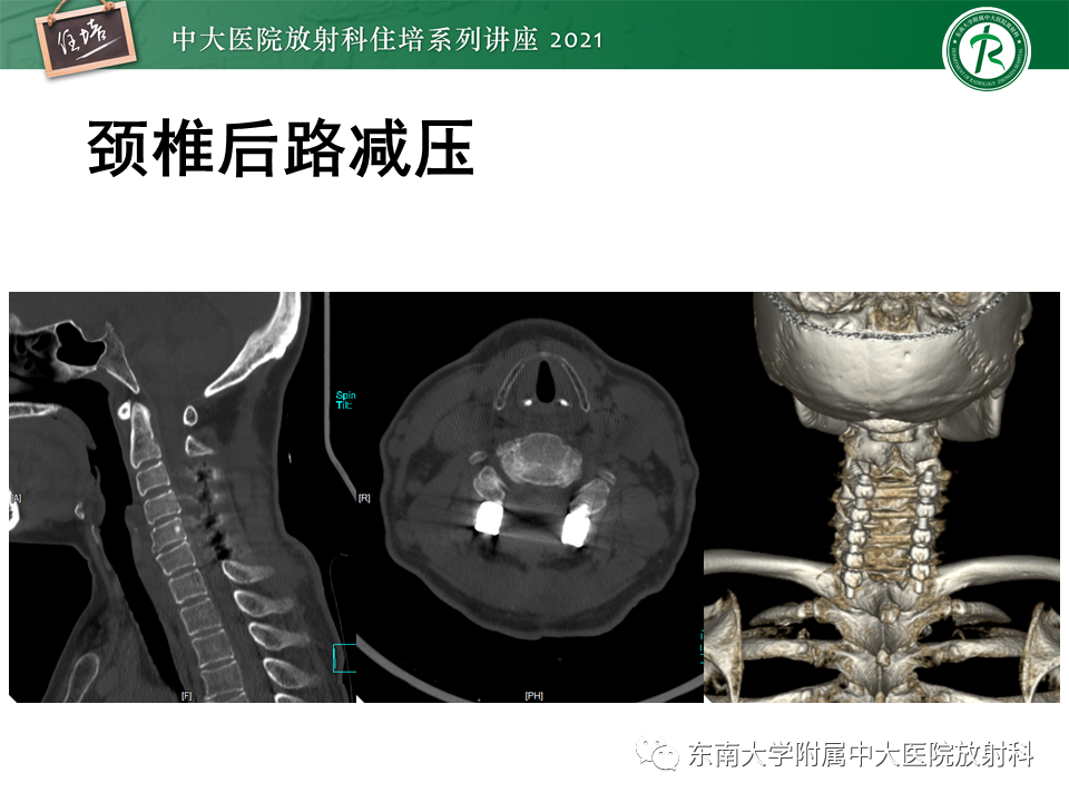 影像PPT - 【PPT】脊柱术后影像学评估-4