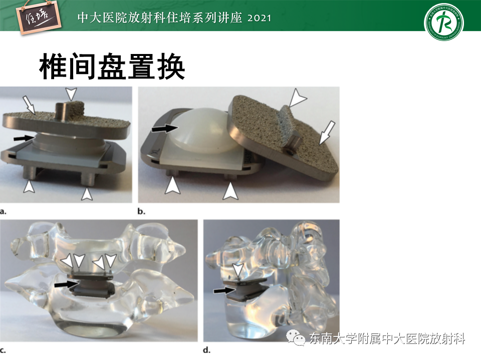 影像PPT - 【PPT】脊柱术后影像学评估-7