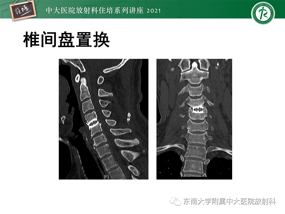 影像PPT - 【PPT】脊柱术后影像学评估-8