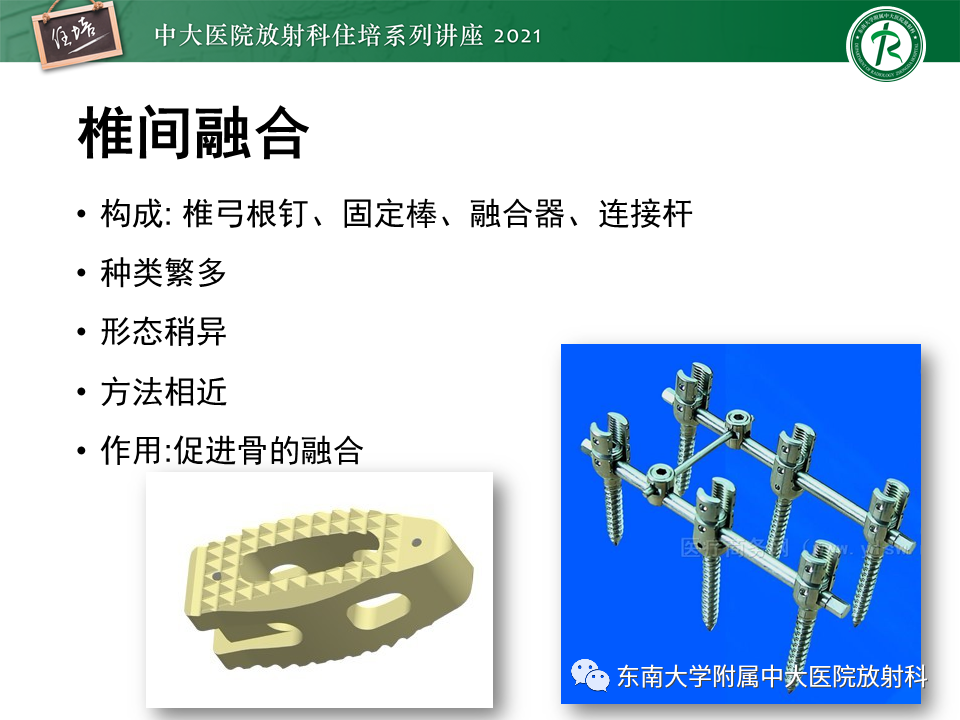 影像PPT - 【PPT】脊柱术后影像学评估-10