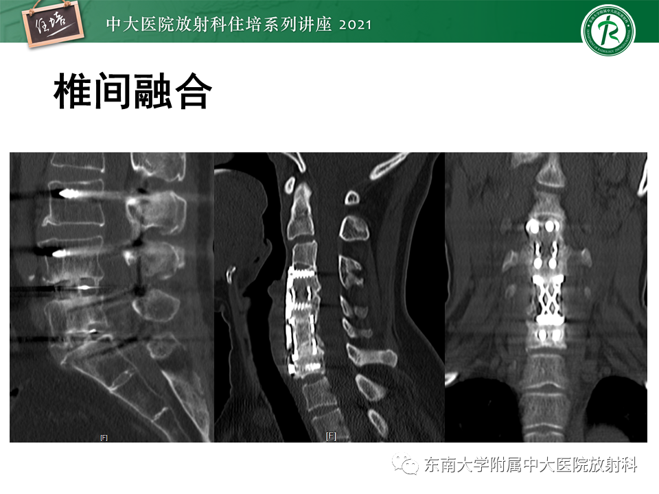 影像PPT - 【PPT】脊柱术后影像学评估-11