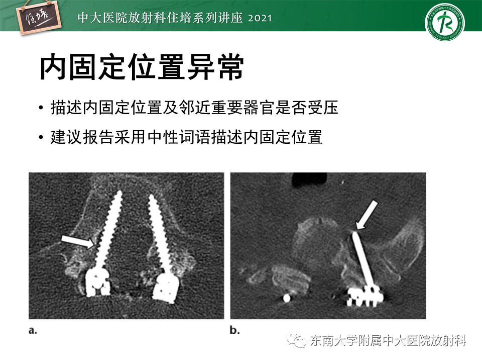 影像PPT - 【PPT】脊柱术后影像学评估-14