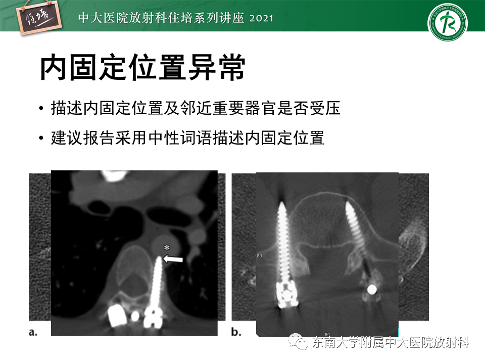 影像PPT - 【PPT】脊柱术后影像学评估-15