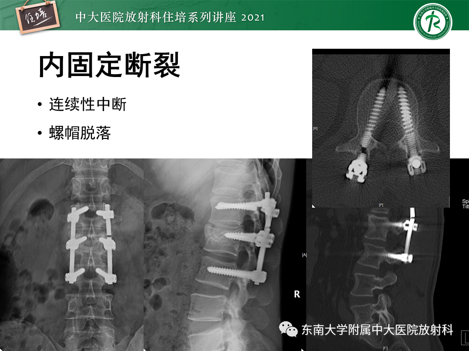 影像PPT - 【PPT】脊柱术后影像学评估-17