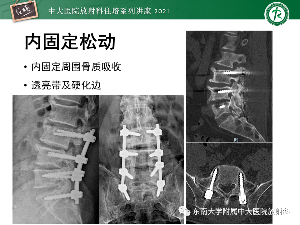 影像PPT - 【PPT】脊柱术后影像学评估-16