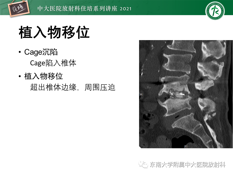 影像PPT - 【PPT】脊柱术后影像学评估-19