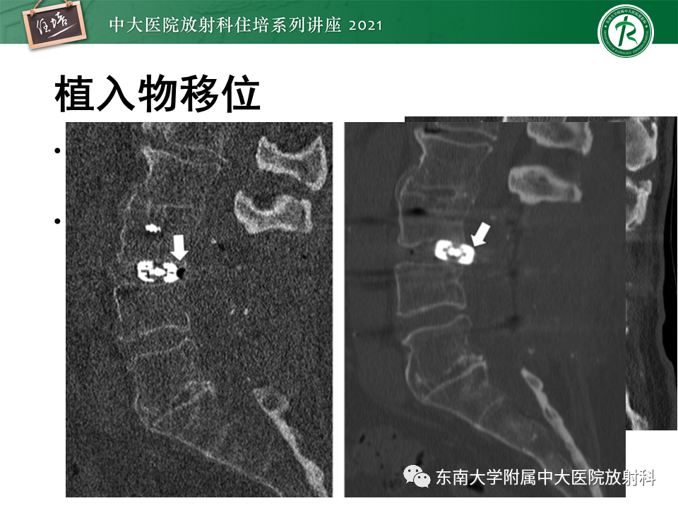 影像PPT - 【PPT】脊柱术后影像学评估-20