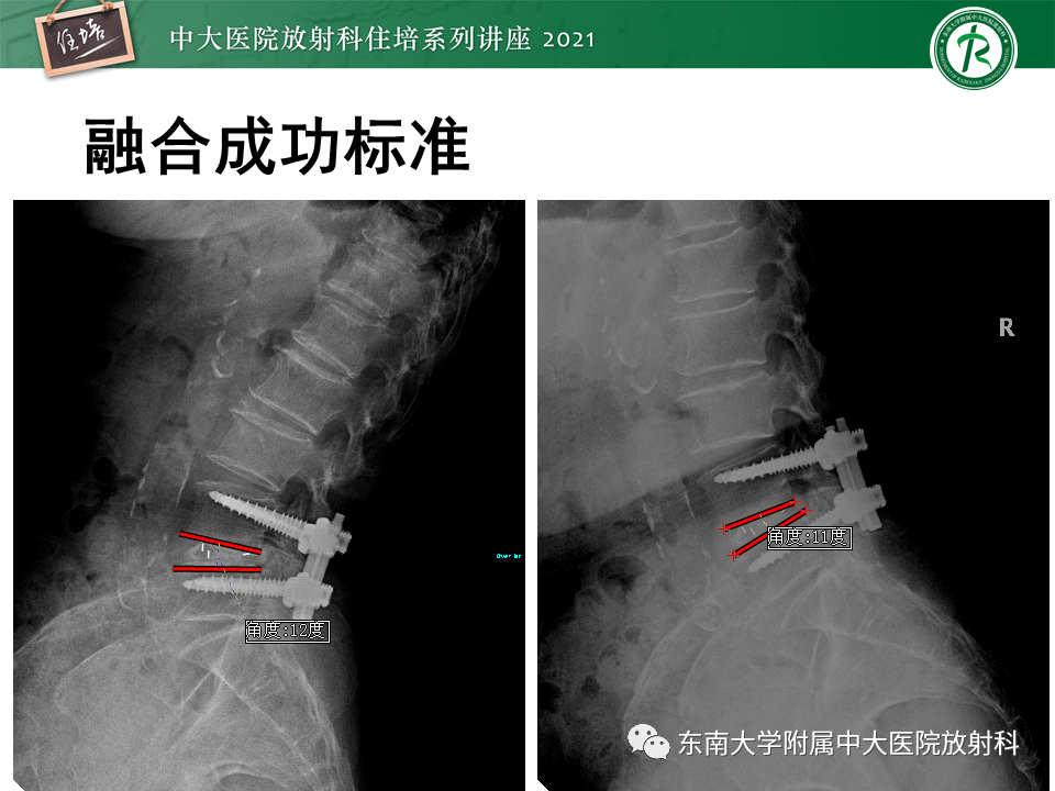 影像PPT - 【PPT】脊柱术后影像学评估-22