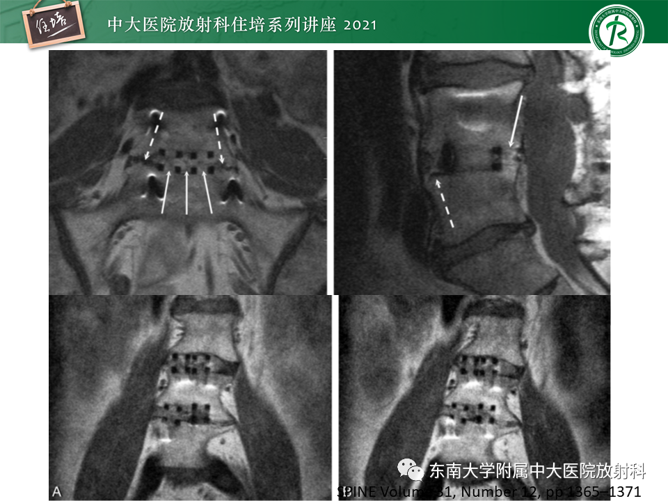 影像PPT - 【PPT】脊柱术后影像学评估-26