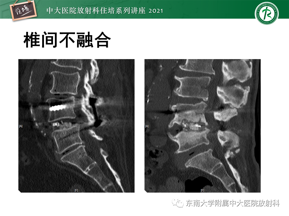 影像PPT - 【PPT】脊柱术后影像学评估-28