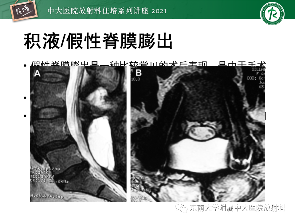 影像PPT - 【PPT】脊柱术后影像学评估-31