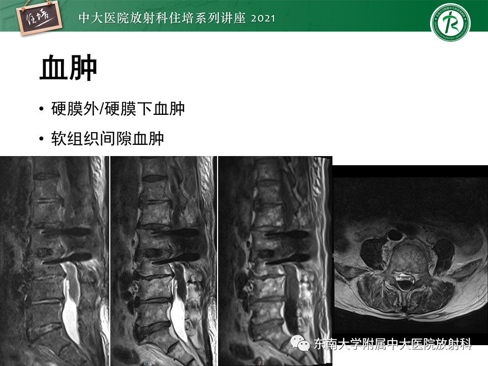 影像PPT - 【PPT】脊柱术后影像学评估-32