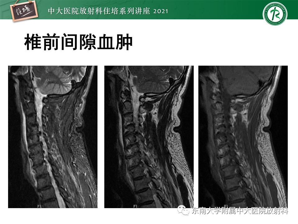 影像PPT - 【PPT】脊柱术后影像学评估-33