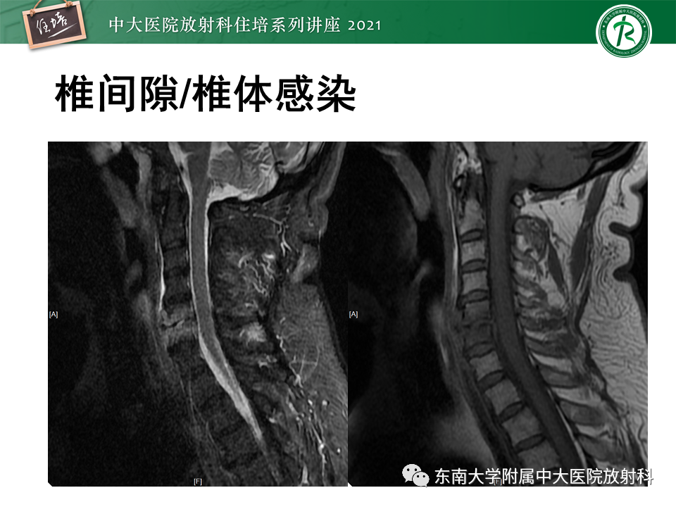 影像PPT - 【PPT】脊柱术后影像学评估-35