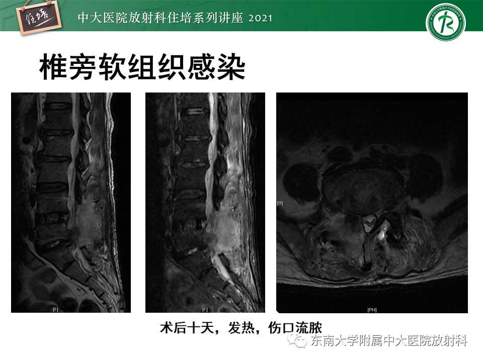 影像PPT - 【PPT】脊柱术后影像学评估-36