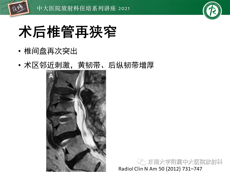 影像PPT - 【PPT】脊柱术后影像学评估-37