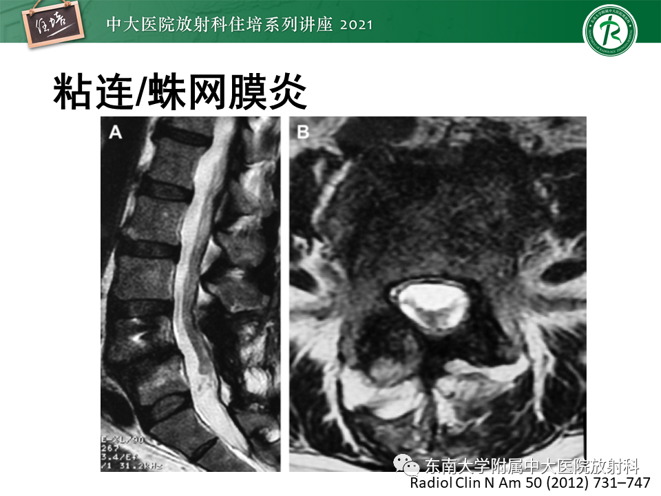 影像PPT - 【PPT】脊柱术后影像学评估-39
