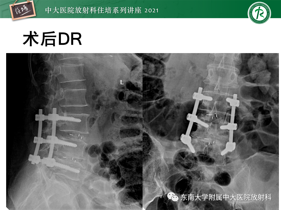 影像PPT - 【PPT】脊柱术后影像学评估-41