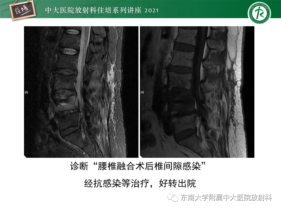 影像PPT - 【PPT】脊柱术后影像学评估-43