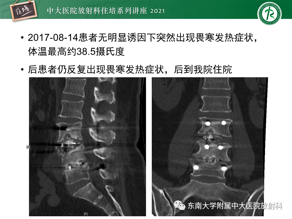 影像PPT - 【PPT】脊柱术后影像学评估-42