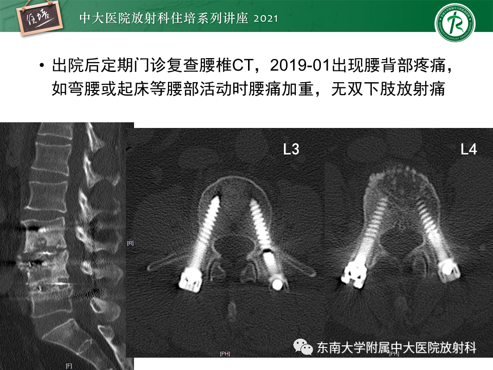 影像PPT - 【PPT】脊柱术后影像学评估-44