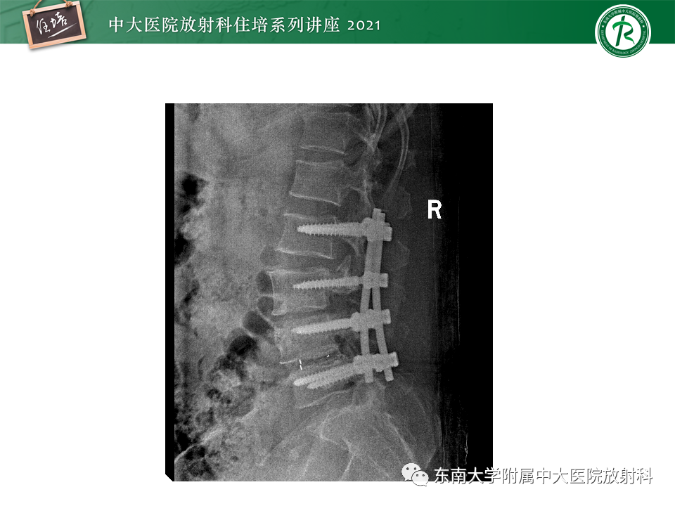 影像PPT - 【PPT】脊柱术后影像学评估-46