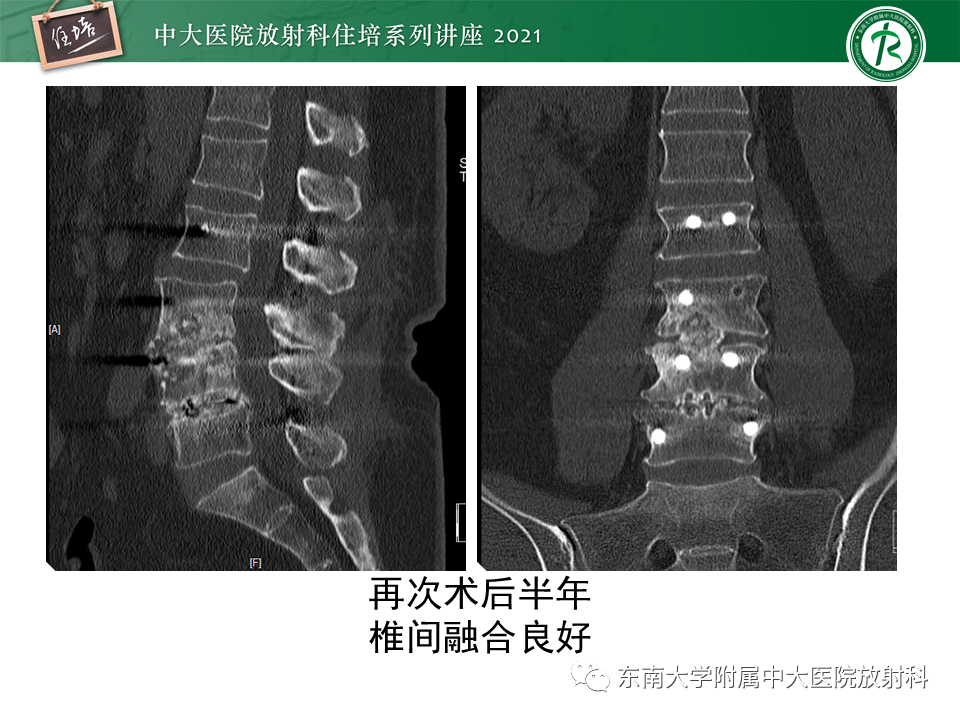 影像PPT - 【PPT】脊柱术后影像学评估-47