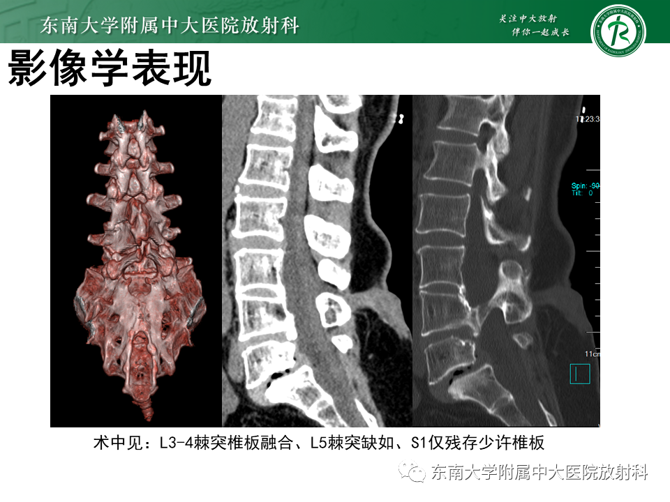影像PPT - 【PPT】隐性神经管闭合不全-3 影像PPT - 【PPT】隐性神经管闭合不全-3