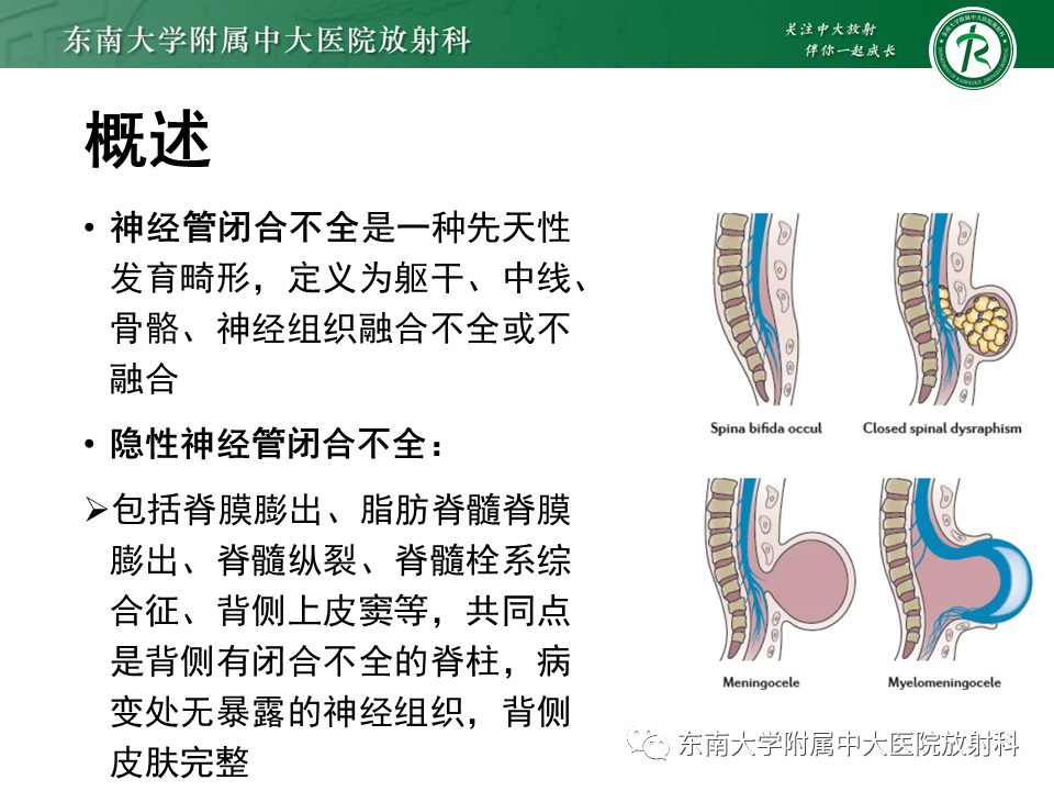 影像PPT - 【PPT】隐性神经管闭合不全-5 影像PPT - 【PPT】隐性神经管闭合不全-5