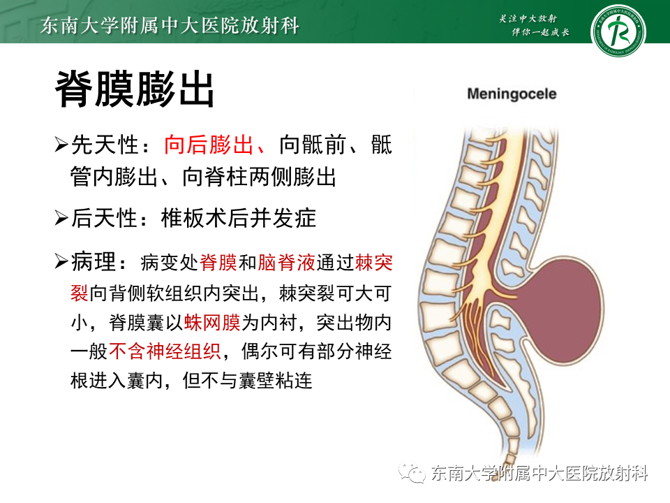 影像PPT - 【PPT】隐性神经管闭合不全-7 影像PPT - 【PPT】隐性神经管闭合不全-7