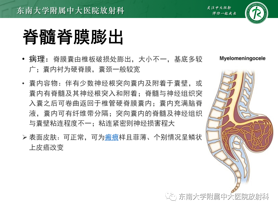 影像PPT - 【PPT】隐性神经管闭合不全-14 影像PPT - 【PPT】隐性神经管闭合不全-14